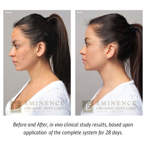 Eminence Organics Acne Advanced Treatment System